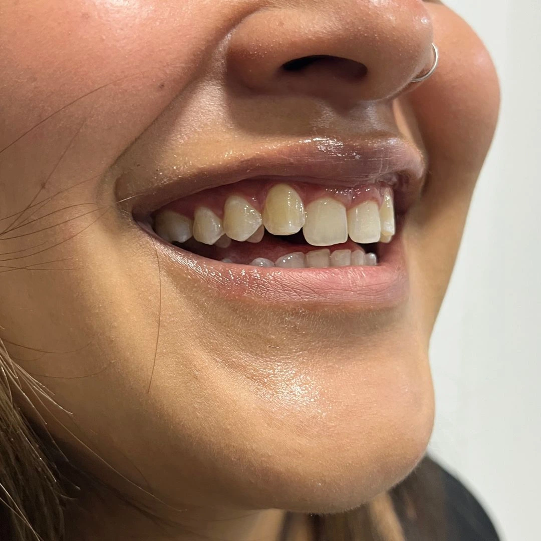 [PATIENT NAME] after smile design