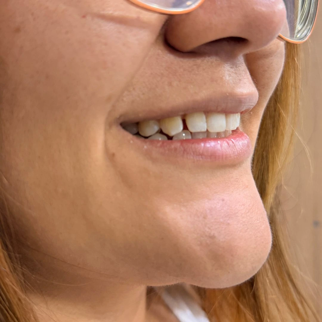 [PATIENT NAME] before smile design