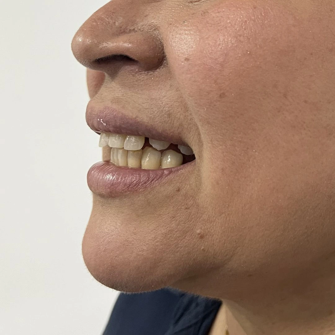 [PATIENT NAME] before smile design