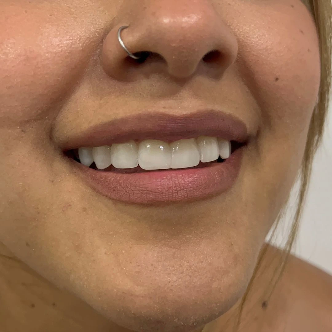 [PATIENT NAME] before smile design